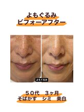 よもぐるみ 桃山台店/ビフォーアフター[よもぎ蒸し]