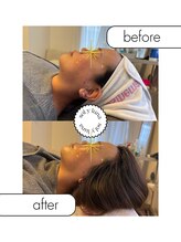 お肌の土台から整える　sol y luna　麻布十番店【肌質改善/エイジングケア】/お肌の土台は炭酸カーボキシーで