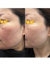 マシュマロハンド/肩こり/冷え/むくみ改善