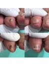 【巻き爪/陥入爪】