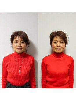 シャルム(Charme)/小顔矯正1回