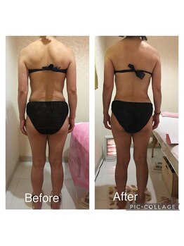 アンフィー 川西能勢口店(Une f`ee)/泡痩身のビフォーアフター★