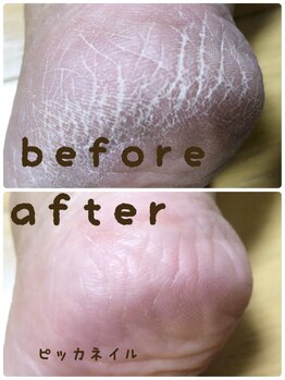 ピッカネイル/