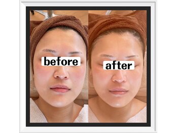 ソワン(soin)/全顔リフトアップ機器で小顔実現