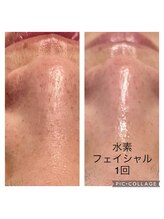 みや美/水素フェイシャル1回