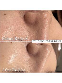 ミエル 神戸店(Miel)/リアボーテ　エステメニュー