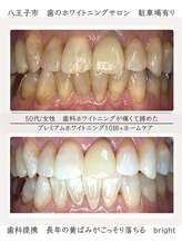 ブライト 八王子(bright)/50代女性/八王子ホワイトニング
