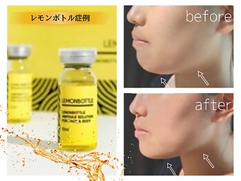 カピリナスパ(Ka.Pilina Spa)/LemonBottle症例