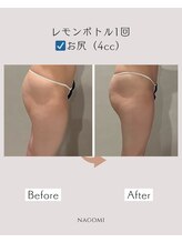 なごみ 菊池店/脂肪撃退【レモンボトル5cc】