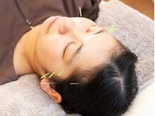 むろたはり きゅう院/【施術風景】美容鍼