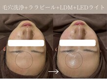 リィ プラス(Riii plus)/毛穴洗浄+ララピール+LDM +LED