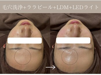 リィ プラス(Riii plus)/毛穴洗浄+ララピール+LDM +LED