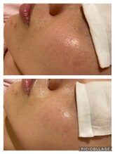 アンフィー 川西能勢口店(Une f`ee)/フォト美顔のビフォーアフター★