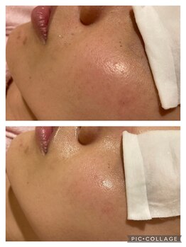 アンフィー 川西能勢口店(Une f`ee)/フォト美顔のビフォーアフター★