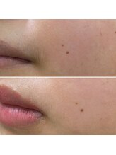 ムーウ(MuuU)/Before→After