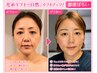 光糸リフトで全顔リフトアップ！