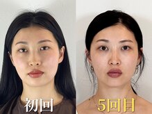 鍼灸院グロリアス 銀座(Glorious)の雰囲気（顔の歪み、リフトアップ、たるみを美容鍼で修正。/美容鍼/小顔）