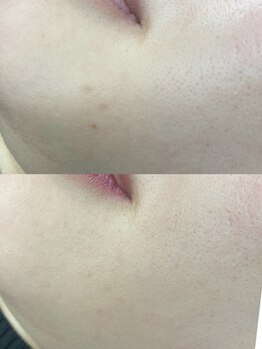 エヌ スタイル(N Style)/シミ改善