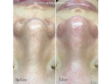 ピエル 北千住店(PIEL)/初めての毛穴エクストラクション