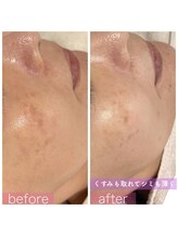 ペルラペティーユ(PERLA PETILLER)/フォト美顔：6回の施術効果