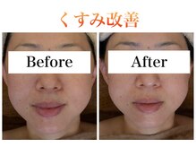 ミムー/before／after