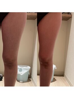 リハーツ(RE;heartz)/★－４℃脂肪冷却★