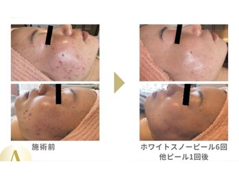 アイル イオン喜連瓜破駅前店/ホワイトスノーピール結果