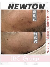 トータルサロンアイビーシー(トータルサロンIBC)/NEWTON シミケア　メンズOK