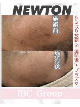 トータルサロンアイビーシー(トータルサロンIBC)/NEWTON シミケア メンズOK