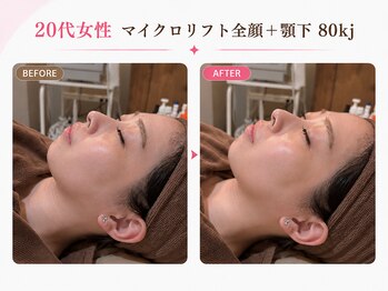 リフト 門前仲町(Lift)/小顔専門店Lift|小顔施術