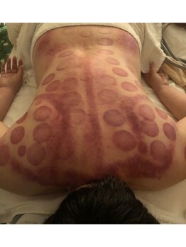 中国整体 らくらく堂/温熱療法吸い玉デトックス