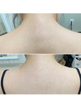 ムーウ(MuuU)/Before→After