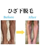ヒゲマスター 小田原店/ひざ下脱毛