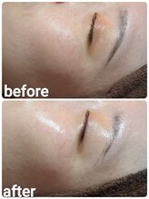 ウララ(ulala)/セラピールビフォアフ