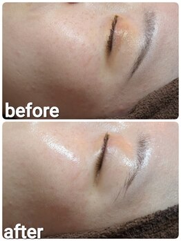 ウララ(ulala)/セラピールビフォアフ