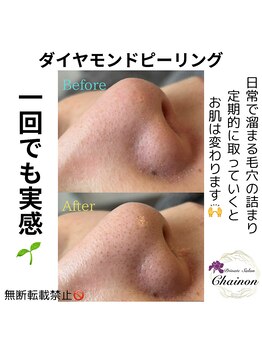 シェノン(Chainon)/フェイシャル毛穴