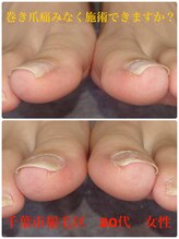 巻き爪じゅん 千葉駅前店/ツラくない巻き爪施術おツ願い！
