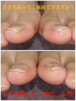 巻き爪じゅん 千葉駅前店/ツラくない巻き爪施術おツ願い！