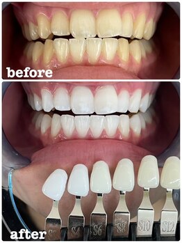 エクシア ホワイトニング 富山店/ビフォーアフター写真☆