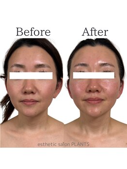 プランツ(PLANTS)/40代／１回／小顔