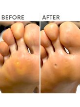 クオッカ(Quokka)/足裏の魚の目ケア