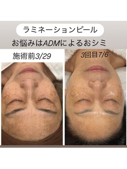 シャンディ(Shandy)/ラミピールはおシミにもおススメ