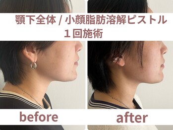 サボラミ(sabor A Mi)/顎下全体 小顔脂肪分解ピストル