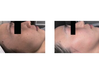 Nビューティー/セルフシミケアプログラム