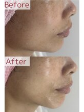 セルフィッシュ ボディ(Selfish body)/小顔になりたいならこちら！