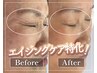 【エイジングケア特化】美容鍼×インディバ+高濃度美容液導入¥15000→¥11000