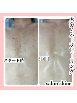 サロンシャイン(Salon Shine)/ハーブリング2回の効果