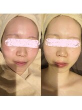 アユアランリンク 札幌店/20代後半/約2週間/赤み軽減