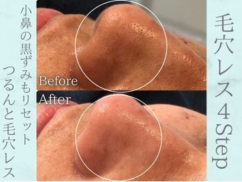 ネオファースト(NeoFirst)/毛穴レス美肌4ステップ