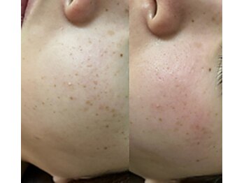 フェリス(feliz)/Before After[シミケア/美白]